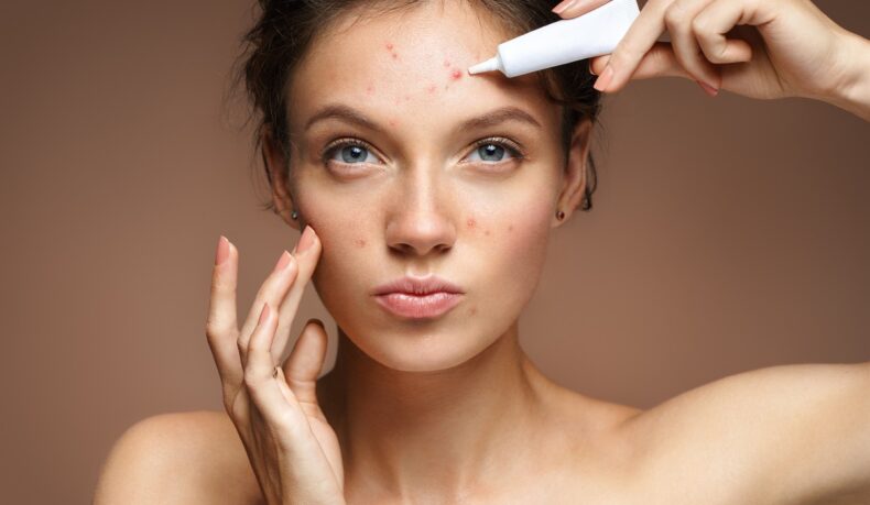 Femeie cu acnee pe frunte și cremă tratament pentru acneea hormonală
