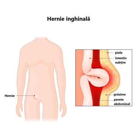 Hernia inghinală. Ce este, cauze, simptome și tratament