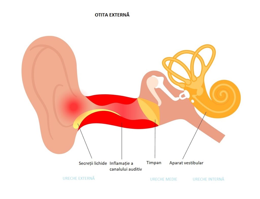 ilustrație ureche afectată de otita externă