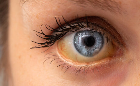 Cauze ale icterului. De ce poate apărea îngălbenirea pielii