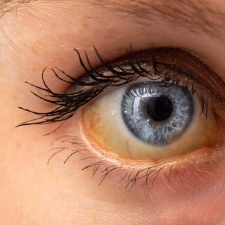 Cauze ale icterului. De ce poate apărea îngălbenirea pielii