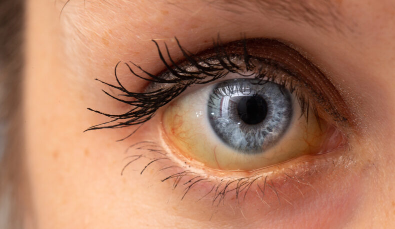 O femeie tânără cu sclera de culoare galbenă din cauza icterului