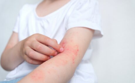 Cauze ale infecțiilor cutanate. Ce simptome pot avea Cauze ale infecțiilor cutanate. Ce simptome pot avea