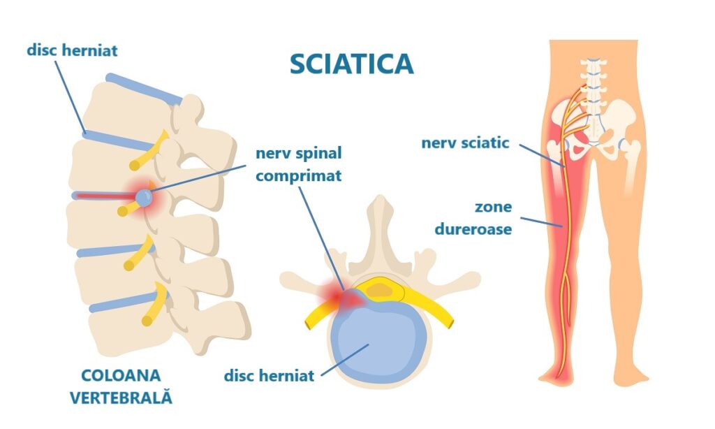 infografic cu localizarea nervului sciatic, coloana vertebrală și aspectul unui disc herniat care provoacă sciatica