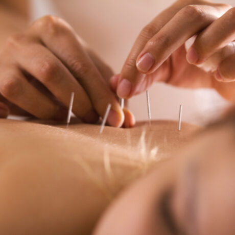 Acupunctura în infertilitate, o terapie cu mai multe beneficii