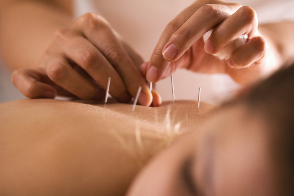 O femeie tânără care urmează un tratament de acupunctură