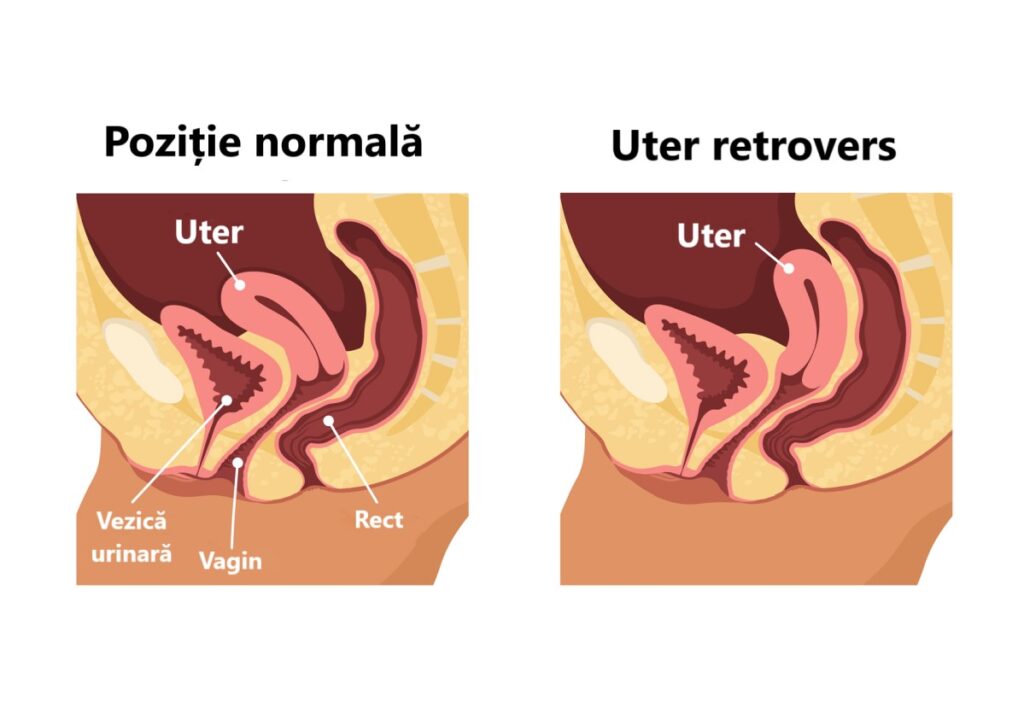 vector uter normal și uter retrovers