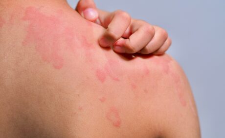 Ce declanșează urticaria cronică și cum o poți preveni