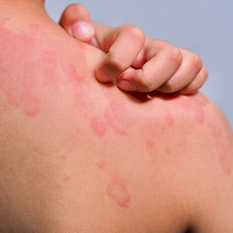 Ce declanșează urticaria cronică și cum o poți preveni