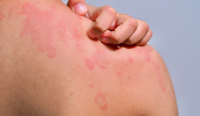 Ce declanșează urticaria cronică și cum o poți preveni