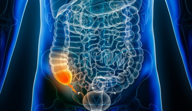 O ilustrație 3D cu apendicele inflamat în cavitatea abdominală, pe fundal negru