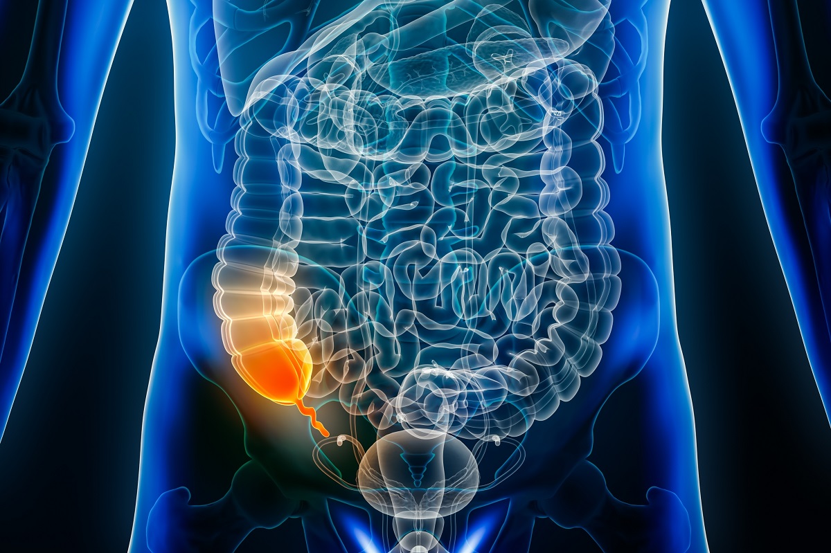 O ilustrație 3D cu apendicele inflamat în cavitatea abdominală, pe fundal negru