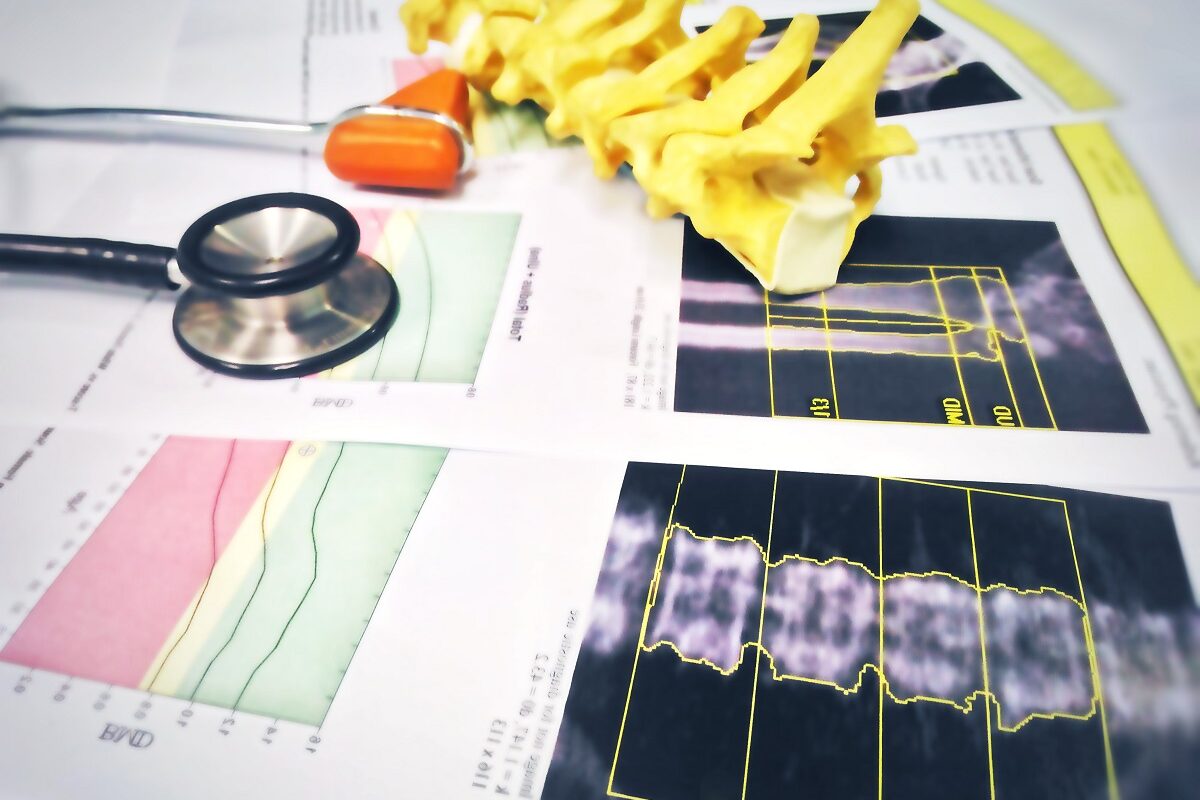 Un stetoscop, o machetă care reprezintă coloana vertebrală și un raport de evaluare a densității osoase după osteodensitometrie