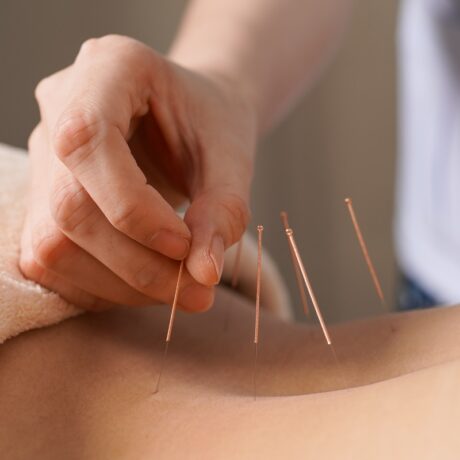 Acupunctura este dureroasă? Cum se simte și cum funcționează acest tratament