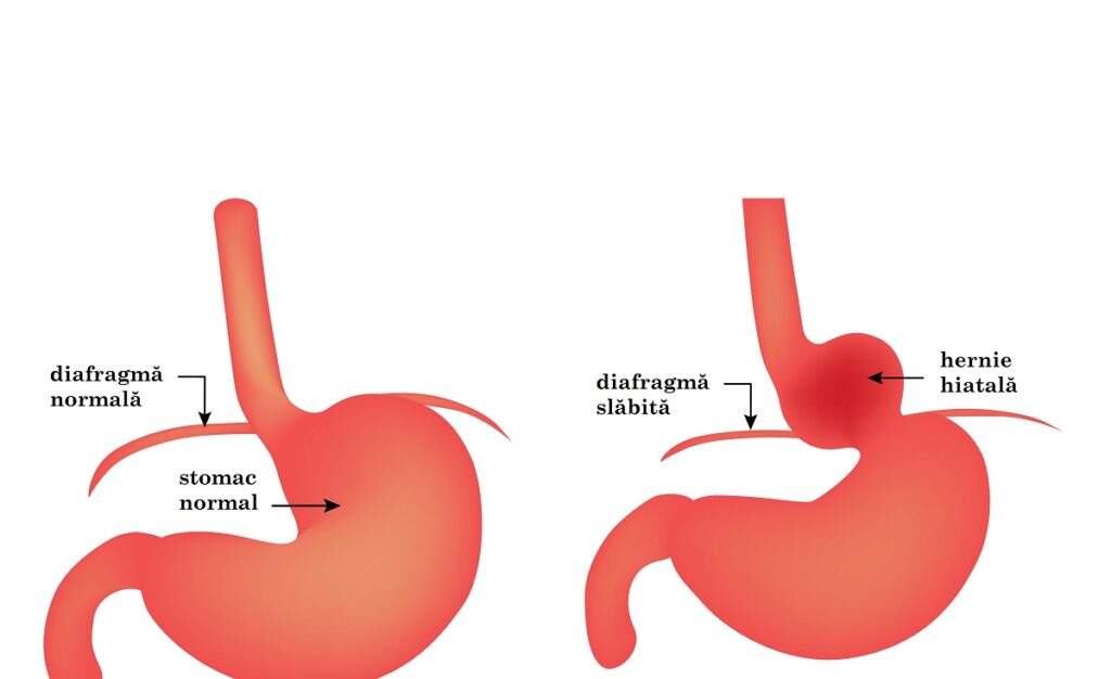 ilustație grafică cu stomac normal și stomac cu hernie hiatală