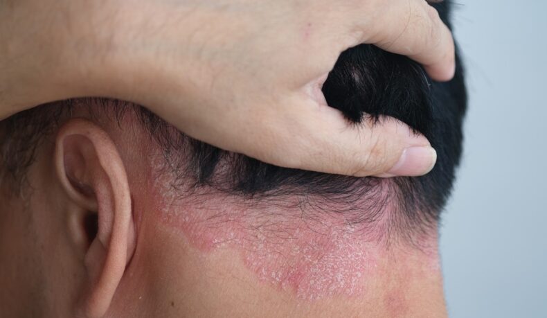 Psoriazisul scalpului: cauze și opțiuni de tratament