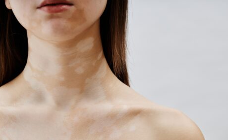 7 simptome de vitiligo ușor de recunoscut