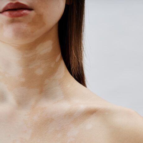 7 simptome de vitiligo ușor de recunoscut