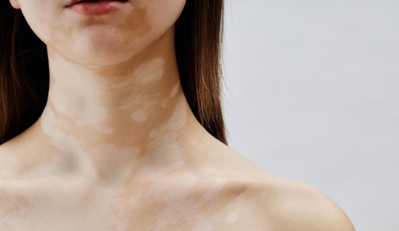 7 simptome de vitiligo ușor de recunoscut