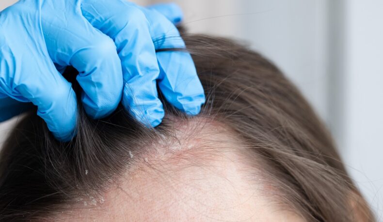 Diferențele dintre dermatita seboreică și psoriazisul scalpului. Cum le poți deosebi