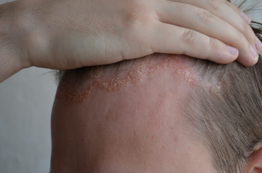close up cu psoriazis pe scalp
