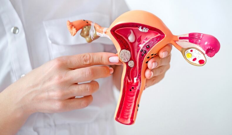 Ginecologul arată cu degetul spre tumorile fibroase pe un model al unui uter feminin cu patologii