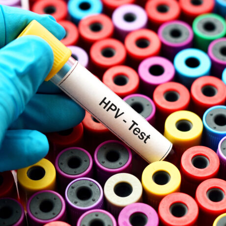 Ce înseamnă un rezultat HPV modificat? Ghid pentru paciente