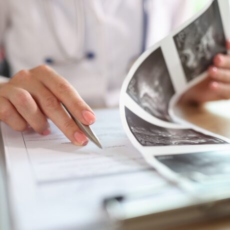 Chist ovarian sau endometriom? Care este diferența și cum pot afecta fertilitatea